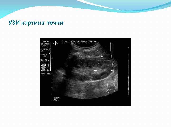УЗИ картина почки 