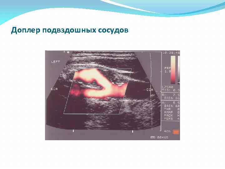 Доплер подвздошных сосудов 