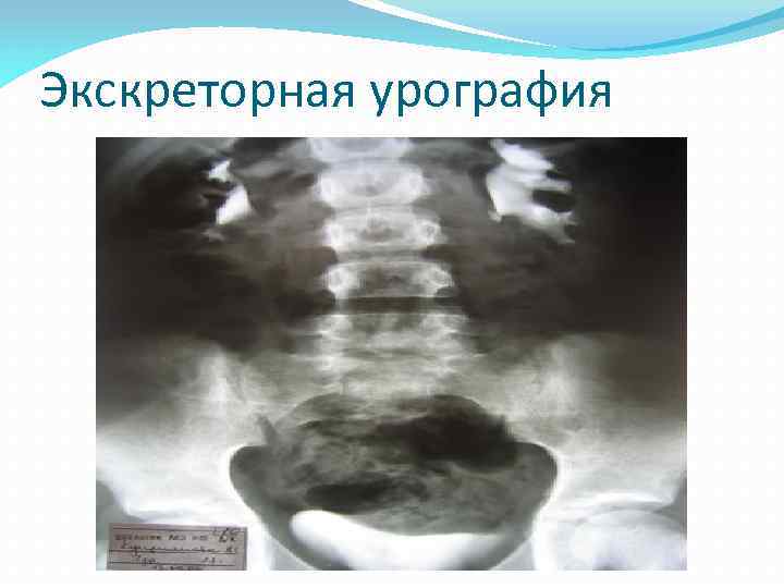 Экскреторная урография 