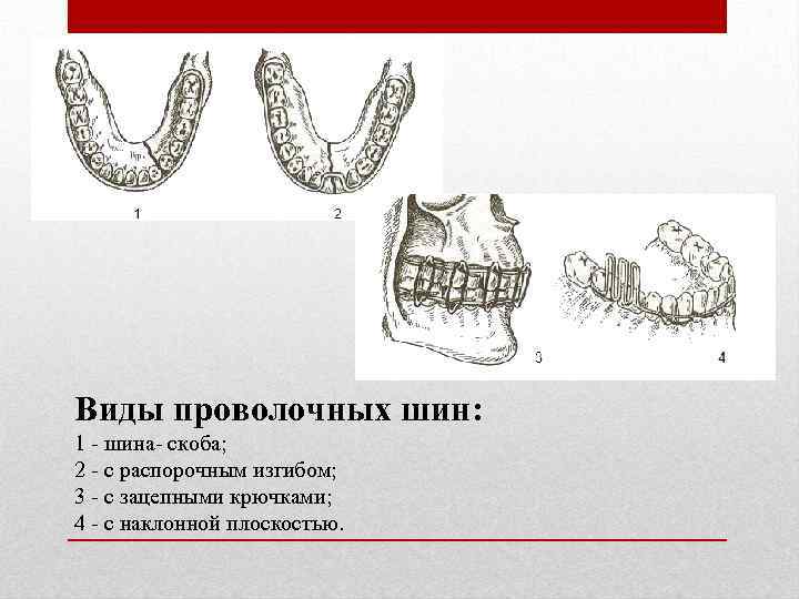 Виды проволочных шин: 1 - шина- скоба; 2 - с распорочным изгибом; 3 -