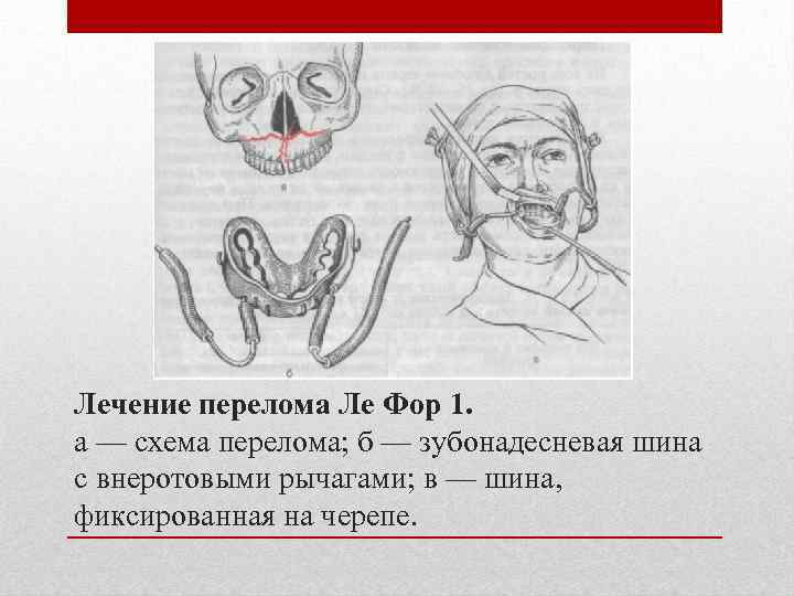 Лечение перелома Ле Фор 1. а — схема перелома; б — зубонадесневая шина с