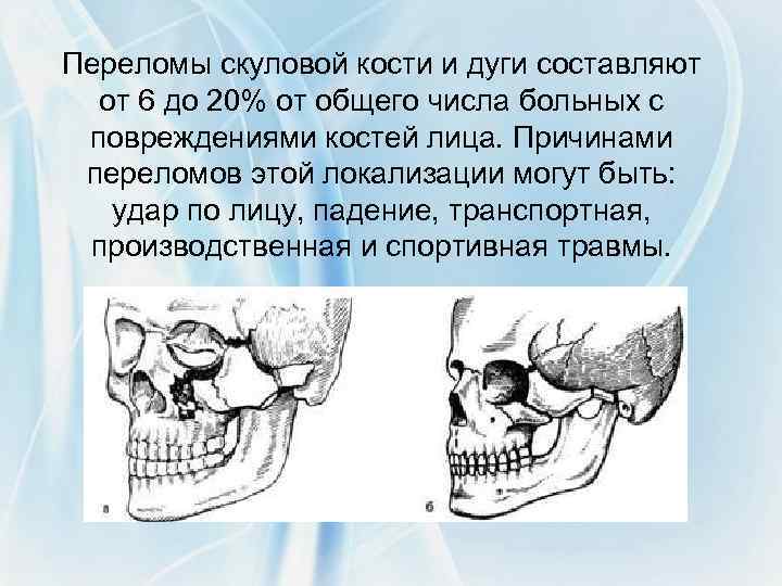 Верхняя скуловая кость