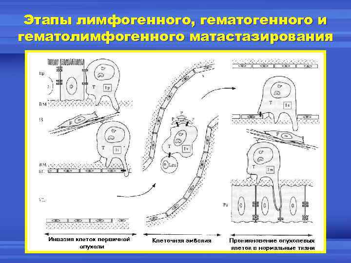 Этапы лимфогенного, гематогенного и гематолимфогенного матастазирования 