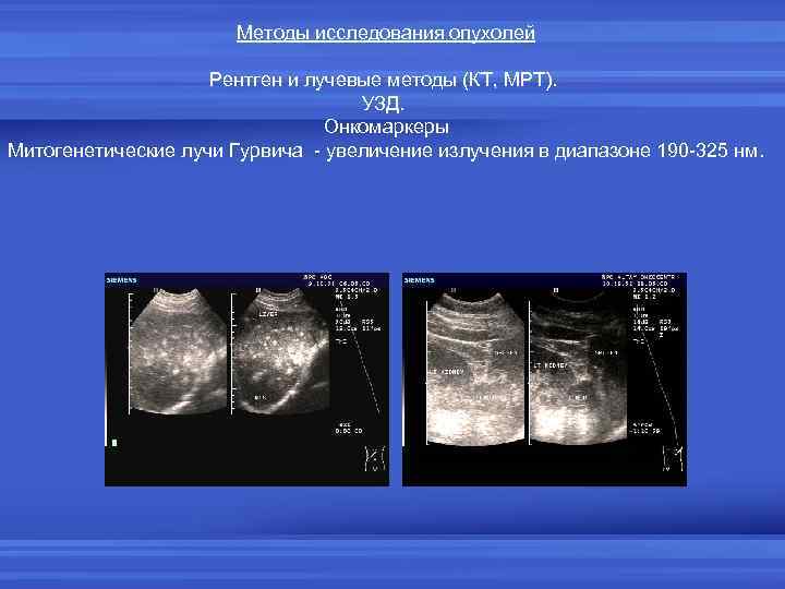 Методы исследования опухолей Рентген и лучевые методы (КТ, МРТ). УЗД. Онкомаркеры Митогенетические лучи Гурвича