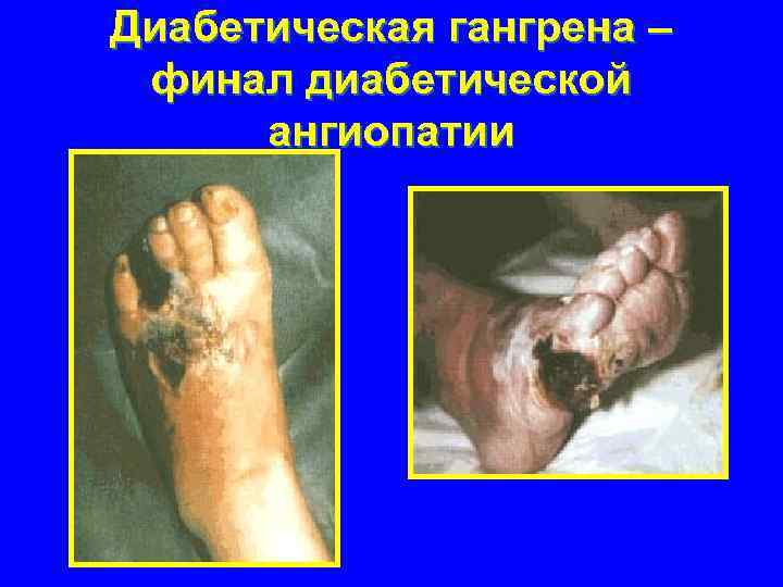 Диабетическая гангрена – финал диабетической ангиопатии 
