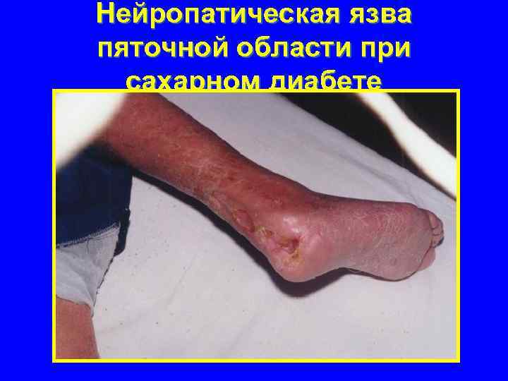 Нейропатическая язва пяточной области при сахарном диабете 