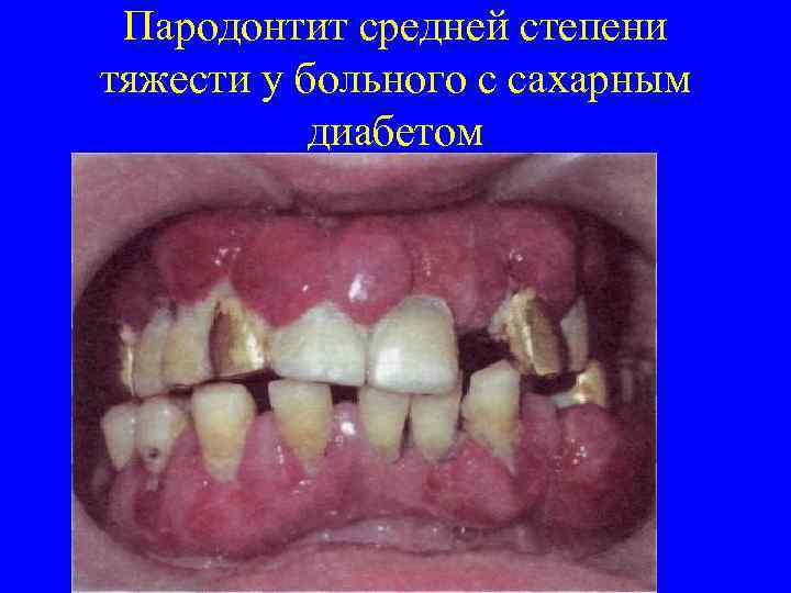 Пародонтит средней степени тяжести у больного с сахарным диабетом 