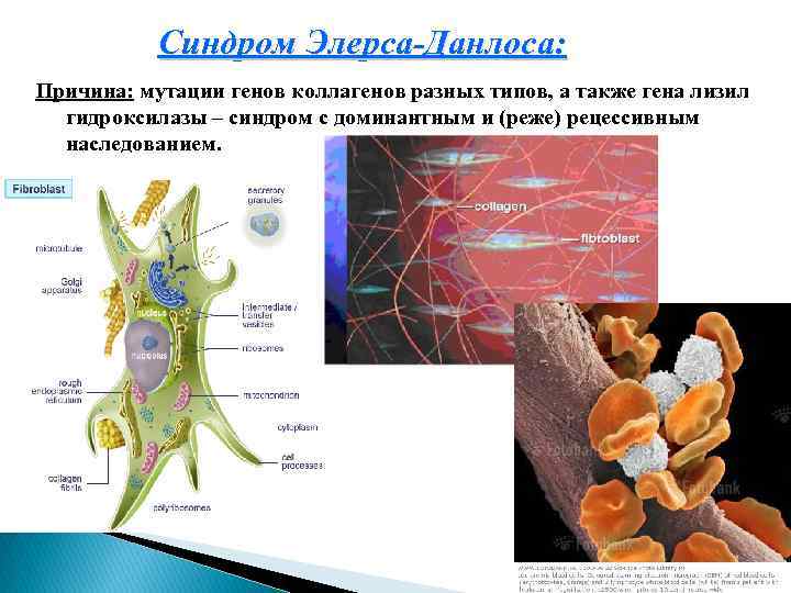 Синдром Элерса-Данлоса: Причина: мутации генов коллагенов разных типов, а также гена лизил гидроксилазы –