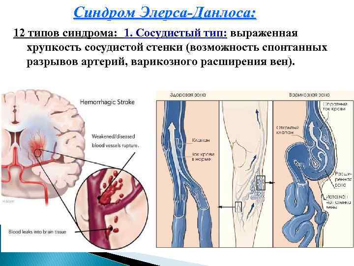 Синдром Элерса-Данлоса: 12 типов синдрома: 1. Сосудистый тип: выраженная хрупкость сосудистой стенки (возможность спонтанных