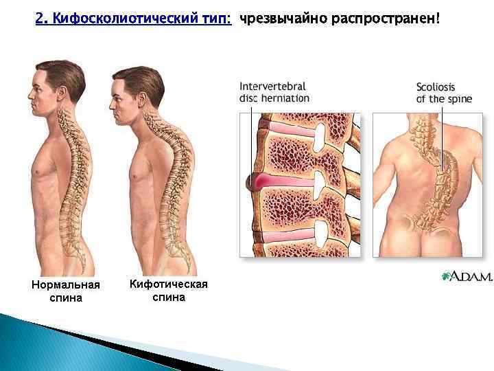 2. Кифосколиотический тип: чрезвычайно распространен! 