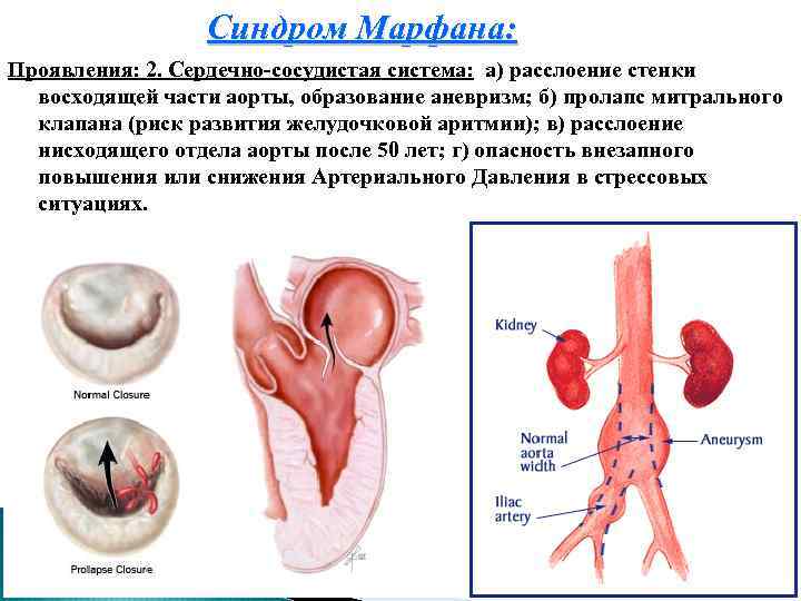 Синдром Марфана: Проявления: 2. Сердечно-сосудистая система: а) расслоение стенки восходящей части аорты, образование аневризм;