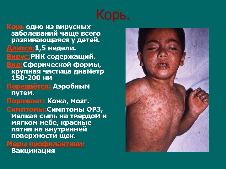 Корь. Корь одно из вирусных заболеваний чаще всего развивающаяся у детей. Длится: 1, 5