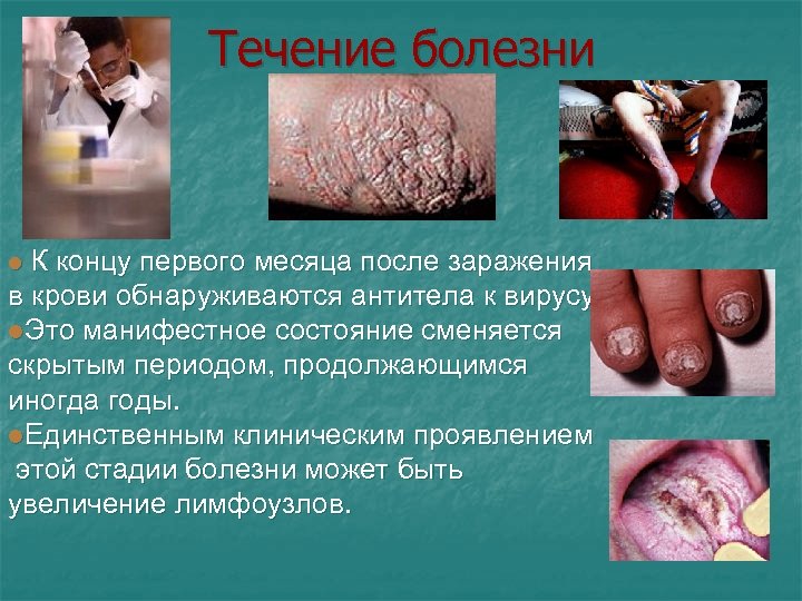 Течение болезни l К концу первого месяца после заражения в крови обнаруживаются антитела к