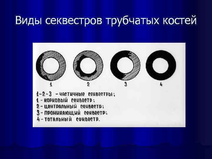 Виды секвестров трубчатых костей 
