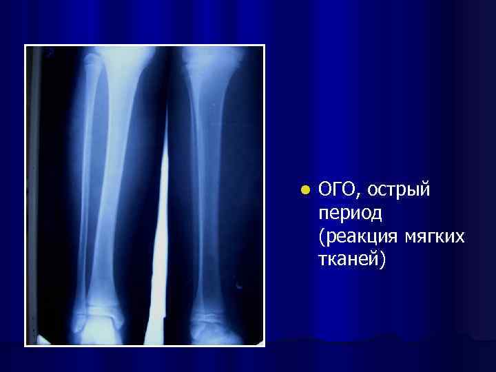 Острый гематогенный остеомиелит у детей презентация