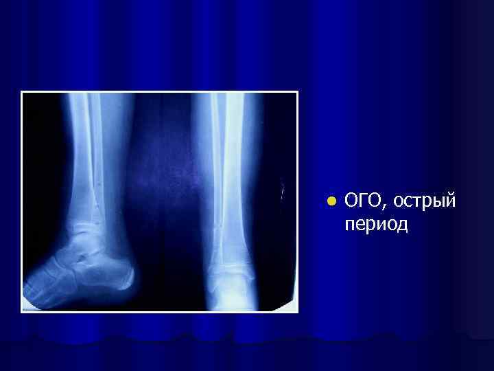 l ОГО, острый период 