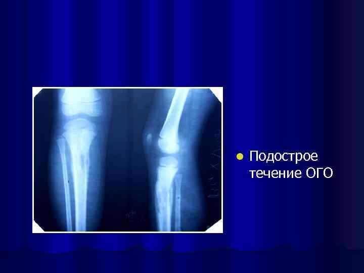 l Подострое течение ОГО 