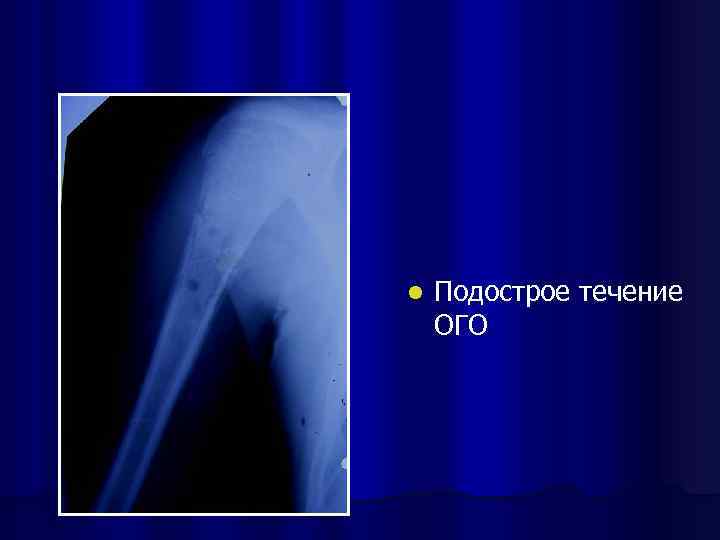 l Подострое течение ОГО 