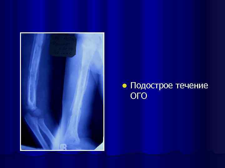 l Подострое течение ОГО 