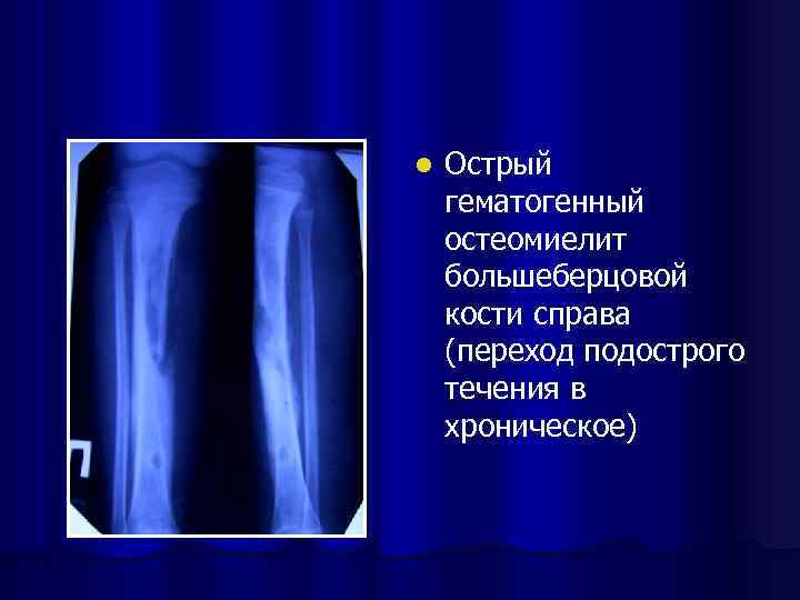 Рентгенодиагностика остеомиелита презентация