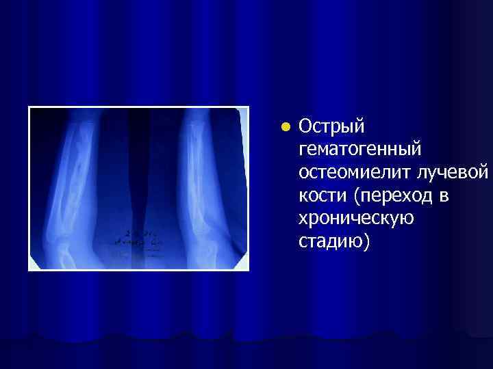 l Острый гематогенный остеомиелит лучевой кости (переход в хроническую стадию) 