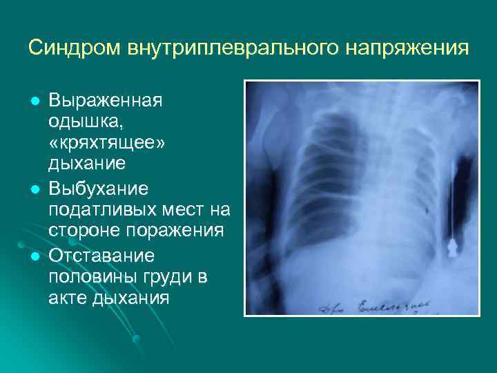 Синдром внутриплеврального напряжения l l l Выраженная одышка, «кряхтящее» дыхание Выбухание податливых мест на