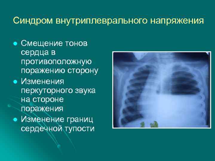 Синдром внутриплеврального напряжения l l l Смещение тонов сердца в противоположную поражению сторону Изменения