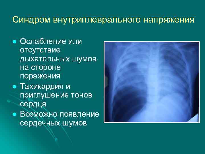 Синдром внутриплеврального напряжения l l l Ослабление или отсутствие дыхательных шумов на стороне поражения