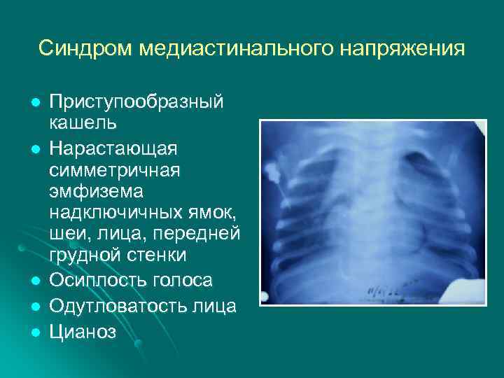 Синдром медиастинального напряжения l l l Приступообразный кашель Нарастающая симметричная эмфизема надключичных ямок, шеи,