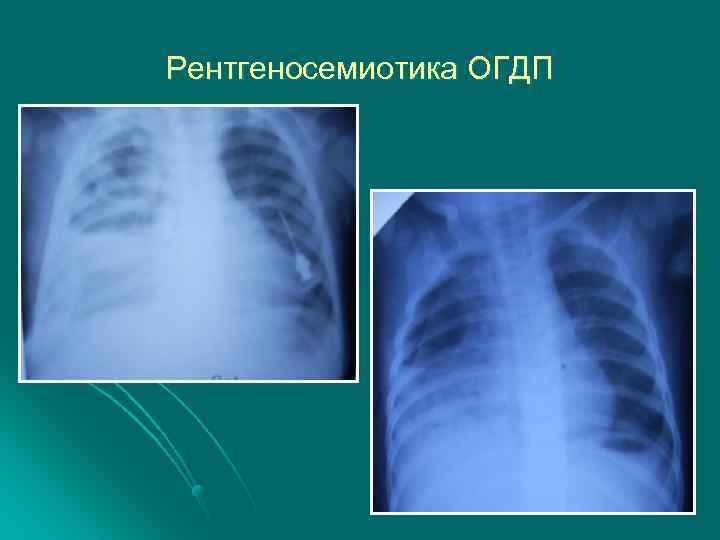 Острая гнойная деструктивная пневмония у детей презентация