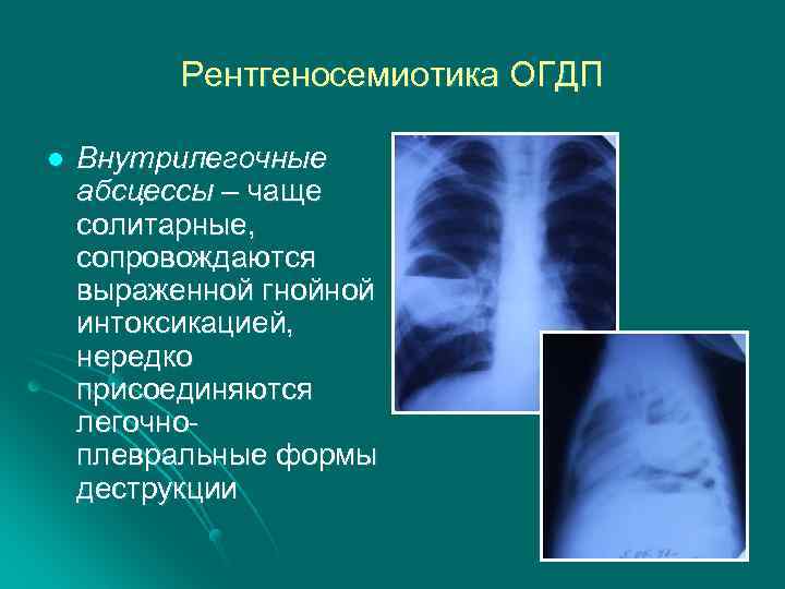 Деструктивная пневмония. Стафилококковая деструктивная пневмония характеризуется. Острая деструктивная пневмония у детей рентген. Легочную форму деструктивной пневмонии. Деструктивная легочная пневмония.