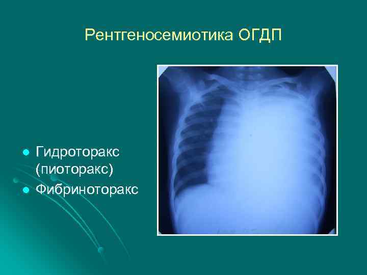 Рентгеносемиотика ОГДП l l Гидроторакс (пиоторакс) Фибриноторакс 