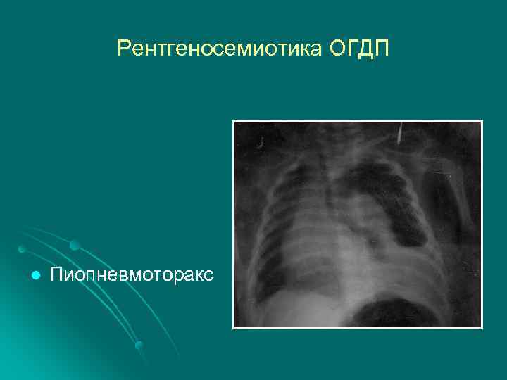 Рентгеносемиотика ОГДП l Пиопневмоторакс 