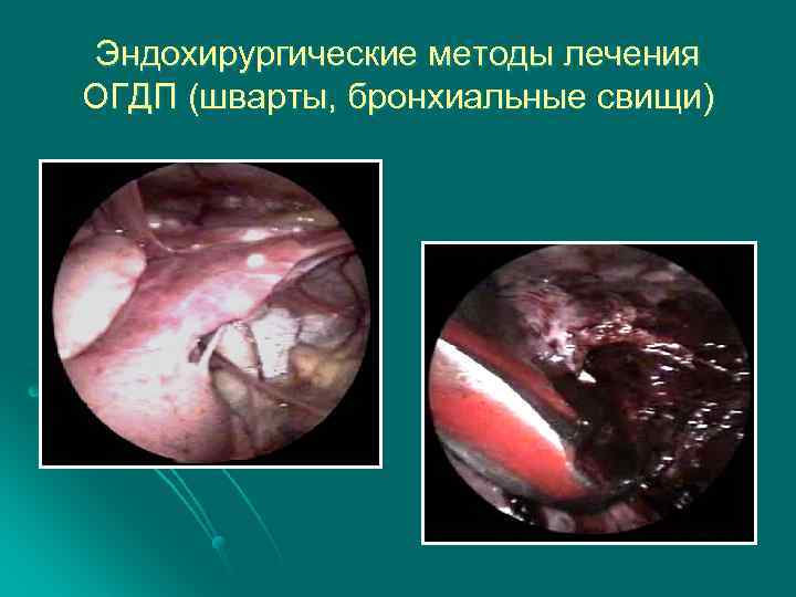 Эндохирургические методы лечения ОГДП (шварты, бронхиальные свищи) 