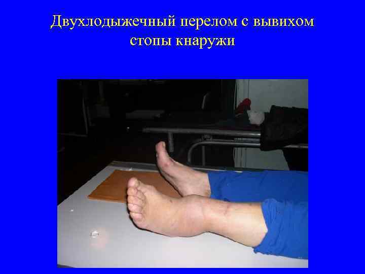 Двухлодыжечный перелом с вывихом стопы кнаружи 