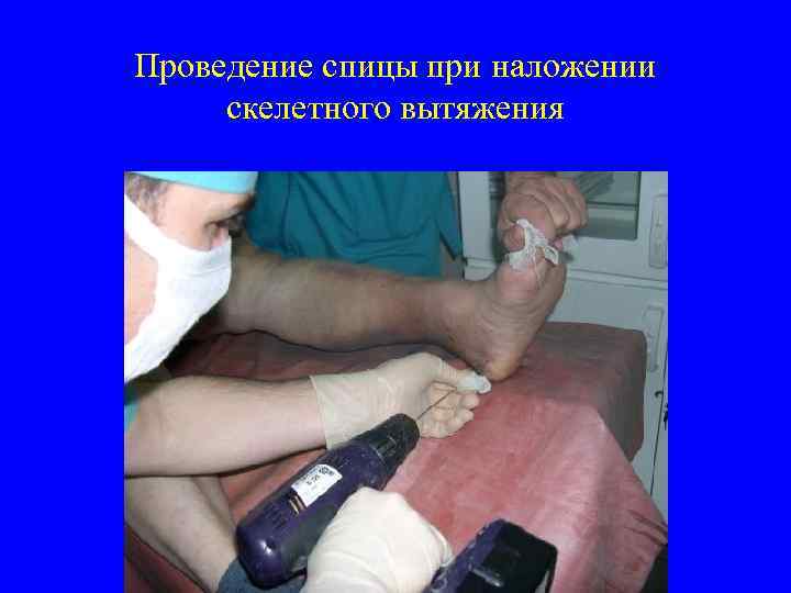 Проведение спицы при наложении скелетного вытяжения 