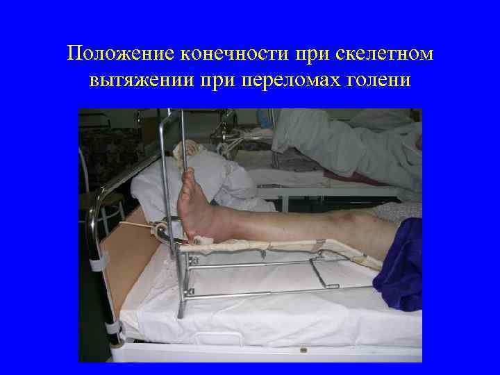 Положение конечности при скелетном вытяжении при переломах голени 