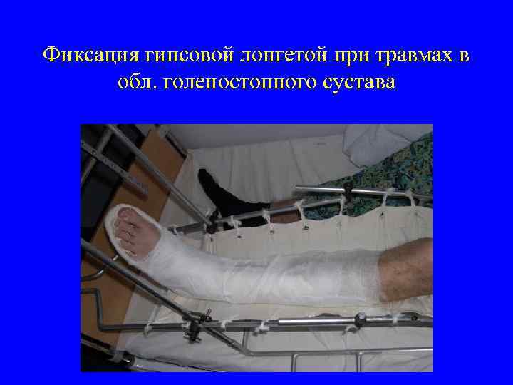 Фиксация гипсовой лонгетой при травмах в обл. голеностопного сустава 