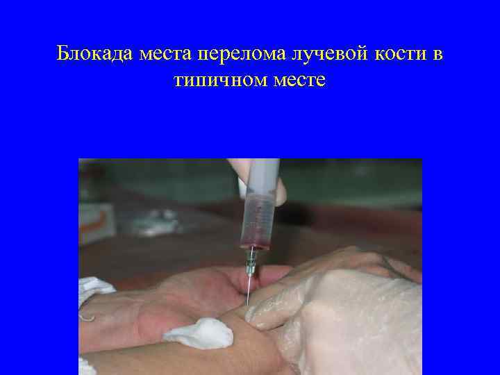 Блокада места перелома лучевой кости в типичном месте 