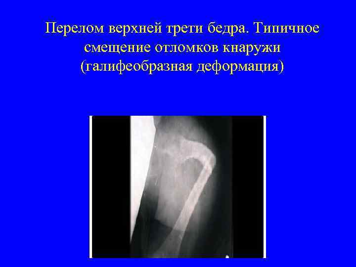 Перелом верхней трети бедра. Типичное смещение отломков кнаружи (галифеобразная деформация) 