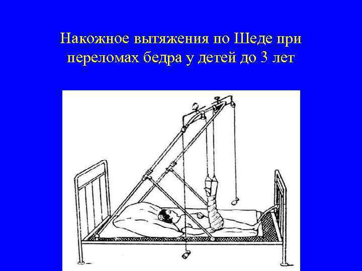 Пяточное вытяжение. Перелом бедра скелетное вытяжение. Скелетное вытяжение бедренной кости. Скелетное вытяжение по шеде. Скелетное вытяжение строение.