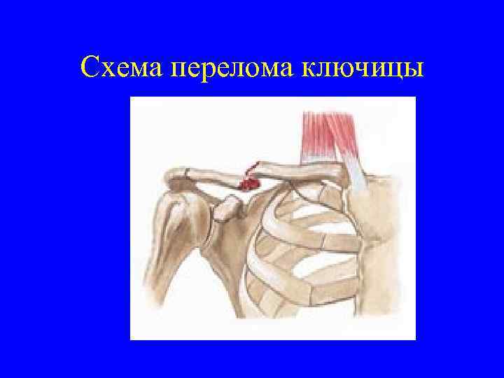 Схема перелома ключицы 