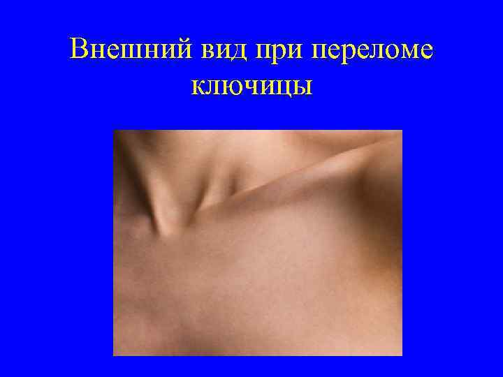 Внешний вид при переломе ключицы 