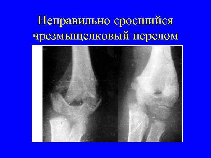 Неправильно сросшийся чрезмыщелковый перелом 