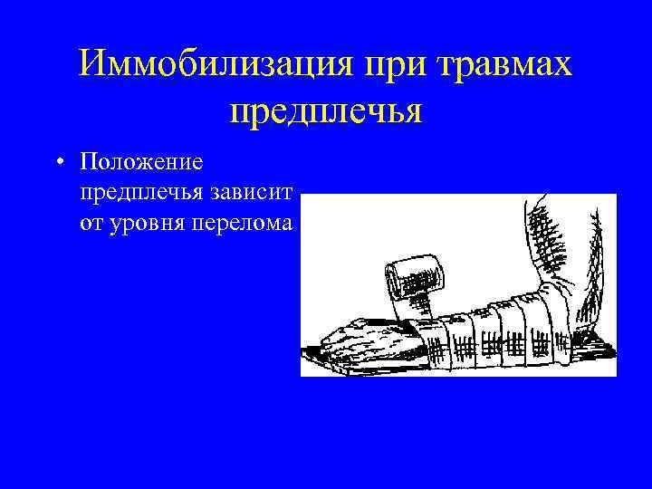 Иммобилизация при травмах предплечья • Положение предплечья зависит от уровня перелома 