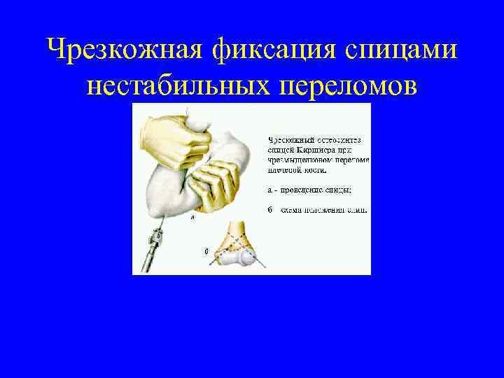 Чрезкожная фиксация спицами нестабильных переломов 