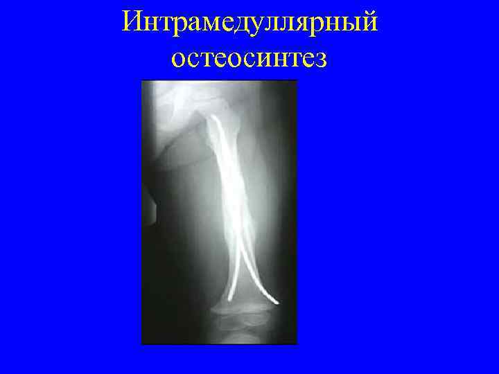 Интрамедуллярный остеосинтез 