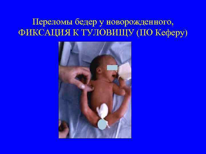 Переломы бедер у новорожденного, ФИКСАЦИЯ К ТУЛОВИЩУ (ПО Кеферу) 