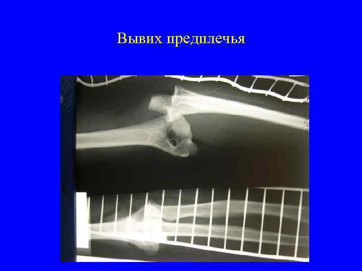 Вывих предплечья 