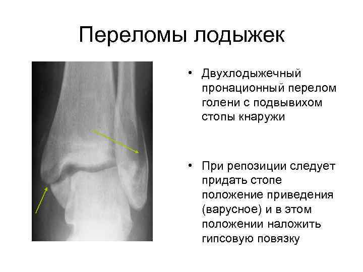 Апикальный перелом. Двухлодыжечный перелом рентген без смещения. Пронационный перелом лодыжки рентген. Подвывих стопы кнаружи схема. Двухлодыжечный перелом кости с подвывихом стопы кнаружи.